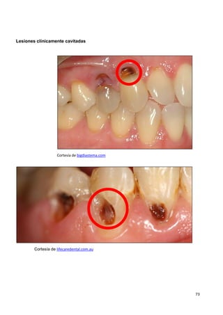 73
Lesiones clínicamente cavitadas
Cortesía de bigdiastema.com
Cortesía de lifecaredental.com.au
 