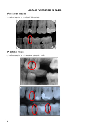 74
Lesiones radiográficas de caries
RA: Estadíos iniciales
1= radiolucidez en la ½ externa del esmalte
RA: Estadíos iniciales
2= radiolucidez en la ½ interna del esmalte ± UAD
 