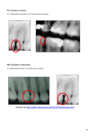 75
RA: Estadíos iniciales
3= radiolucidez limitada al 1/3 externo de la dentina
RB: Estadíos moderados
4= radiolucidez hasta 1/3 medio de la dentina
Cortesía de http://dc681.4shared.com/doc/Q-C5tOw2/preview.html
 