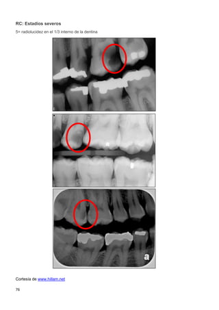 76
RC: Estadíos severos
5= radiolucidez en el 1/3 interno de la dentina
Cortesía de www.hillam.net
 