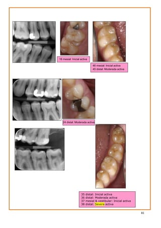 81
24 distal: Moderada activa
35 distal: Inicial activa
36 distal: Moderada activa
37 mesial & vestibular: Inicial activa
38 distal: Severa activa
16 mesial: Inicial activa
46 mesial: Inicial activa
45 distal: Moderada activa
 