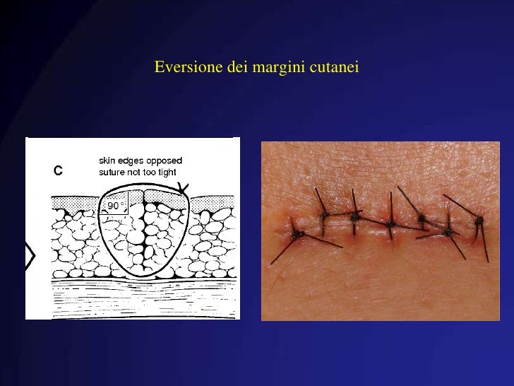 Guarigione delle ferite e sua patologia