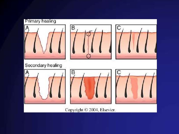 Guarigione delle ferite e sua patologia