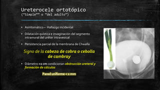 Ureterocele ortotópico
 