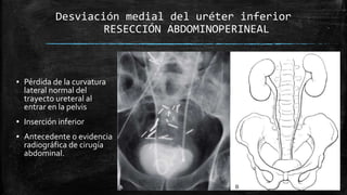 Desviación
lateral del
uréter superior
ANEURISMA AÓRTICO
ABDOMINAL
• Desviación lateral
unilateral de los 2/3
superiores d...