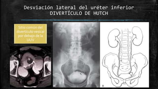 ▪ Hombres de mediana edad
▪ Unilaterales
▪ Uréter derecho
▪ Agujero ciático mayor
Desviación lateral del uréter inferior
H...