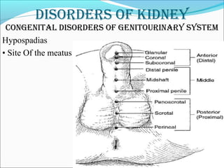DisorDers of kiDney
Congenital DisorDers of genitourinary system
Hypospadias
• Site Of the meatus
 