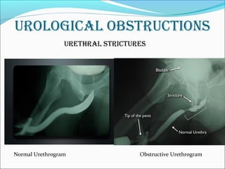 Steps Urethrogram genitourinary disorders (medical surgical nursing) | PPT