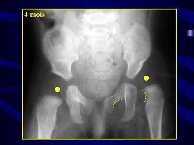 Dysplasie Dislocation Cong nitale De La Hanche RKIF dysplasie-dislocation-cong-nitale-de-la-hanche-rkif