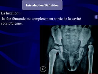 La dysplasie : défaut architectural du développement de
la hanche, d’expression essentiellement radiologique.
 