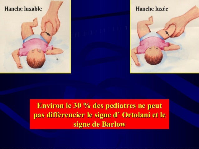 La Luxation Congenitale De La Hanche