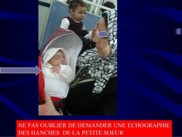 La Luxation Congenitale De La Hanche