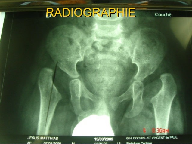 Luxation Cong nitale De La Hanche Diagnostic Radiologique TLWK luxation-cong-nitale-de-la-hanche-diagnostic-radiologique-tlwk