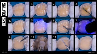 1 2 3
5 6 7
11 13
4
8
COATING
RESIN
 