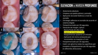 ELEVACION DE MARGEN PROFUNDO
1 2
3 6
1. Aislamiento absoluto
2. Limpieza con piedra pómez y arenado
3. Aplicación de ácido fosfórico a nivel de
esmalte
4. Estrategia adhesiva en esmalte de acuerdo al
sistema elegido
5. Fotopolimerizado por 20 segundos
6. Elevación de margen, aplicar:
- Resina fluida de alta carga
(espesor no mayor a 2 mm)
fotopolimerizar posterior a 4 minutos
- Aplicación de resina compuesta por
incrementos no mayores a 2 mm
7. Fotopolimerizado por 20 segundos.
8. Cubrir con glicerina todas las superficies por
completo y fotopolimerizar por 40 segundas
en diferentes direcciones
 