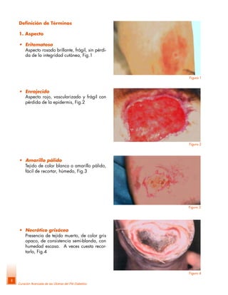 Curación Avanzada de las Úlceras del Pié Diabético
8
• Amarillo pálido
Tejido de color blanco o amarillo pálido,
fácil de recortar, húmedo, Fig.3
• Necrótico grisáceo
Presencia de tejido muerto, de color gris
opaco, de consistencia semi-blanda, con
humedad escasa. A veces cuesta recor-
tarlo, Fig.4
Definición de Términos
1. Aspecto
• Eritematoso
Aspecto rosado brillante, frágil, sin pérdi-
da de la integridad cutánea, Fig.1
• Enrojecido
Aspecto rojo, vascularizado y frágil con
pérdida de la epidermis, Fig.2
Figura 1
Figura 2
Figura 3
Figura 4
 