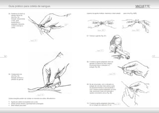 03. Aderência do bisel na
parede interna da
veia (Fig. 24).
Solução: desconectar
o tubo, girar
suavemente o
adaptador, liberando
o bisel e reiniciar a
coleta.
04. Colabamento da
veia (Fig. 25).
Solução: diminuir a
pressão do garrote.
Outras situações podem ser criadas no momento da coleta, dificultando-a:
• Agulha de calibre incompatível com a veia.
• Estase venosa devido a garroteamento prolongado.
• Bisel voltado para baixo.
superior da agulha múltipla, mantendo o bisel voltado para cima (Fig. 06/B).
07. Colocar o garrote (Fig. 07).
08. O sistema agulha-adaptador deve ser
apoiado na palma da mão e seguro
firmemente entre o indicador e o
polegar (Fig. 08).
09. No ato da punção, com o indicador ou
polegar de uma das mãos esticar a pele
do paciente firmando a veia escolhida e
com o sistema agulha-adaptador na outra
mão, puncionar a veia com precisão e
rapidez (movimento único) (Fig. 09).
10. O sistema agulha-adaptador deve estar
em um ângulo de coleta de 15º em
1118
Guia prático para coleta de sangue.
Figura - 24
Figura - 25
Figura - 09
Figura - 08
Figura - 07
Figura - 06/A Figura - 06/B
 