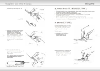 relação ao braço do paciente (Fig. 10)
11. Segurando firmemente o sistema agulha-
adaptador com uma das mãos, com a
outra pegar o tubo de coleta a ser
utilizado e conectá-lo ao adaptador.
NOTA: Sempre que possível, a mão que
estiver puncionando deverá controlar o
sistema, pois durante a coleta, a
mudança de mão poderá provocar
alteração indevida na posição da agulha
(Fig. 11).
12. Com o tubo de coleta dentro do
adaptador, pressione-o com o polegar, até
que a tampa tenha sido penetrada
(Fig. 12/A e B).
NOTA: Sempre manter o tubo pressionado
pelo polegar assegurando um ótimo
preenchimento.
13. Tão logo o sangue flua para dentro do tubo
coletor, o garrote deve ser retirado. Porém,
Algumas dificuldades podem surgir pela
inexperiência do uso do sistema a vácuo,
sendo a mais freqüente a falta de fluxo
sangüíneo para dentro do tubo.
Possíveis causas:
01. A punção foi muito profunda e
transfixou a veia (Fig. 22).
Solução: retrair a agulha.
02. A agulha se localizou ao lado da veia,
sem atingir a luz do vaso (Fig. 23).
Solução: apalpar a veia, localizar sua
trajetória e corrigir o posicionamento
da agulha, aprofundando-a.
12
• Pacientes idosos ou em uso de anticoagulantes, devem manter pressão sobre o local de punção
por cerca de 3 minutos ou até parar o sangramento.
• Orientar para não carregar peso imediatamente após a coleta.
• Observar se não está usando relógio, pulseira ou mesmo vestimenta que possa estar
garroteando o braço puncionado.
• Orientar para não massagear o local da punção enquanto pressiona o local.
• A compressão do local de punção é de responsabilidade do coletor. Se não puder executá-lo,
deverá estar atento à maneira do paciente fazê-lo.
V - Cuidados Básicos com o Paciente após a Coleta
VI - Dificuldades na Coleta
17
Guia prático para coleta de sangue.
Figura - 22
Figura - 23
Figura - 12/BFigura - 12/A
Figura - 11
Figura - 10
 