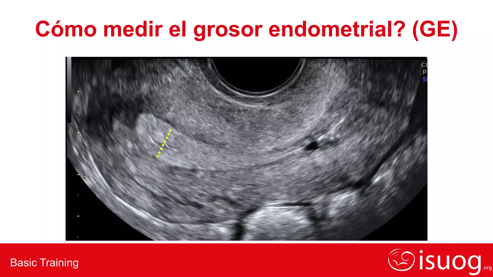 GUIA DE ECOGRAFIA DE utero-cuello-y-endometrio-rev-CV-1019.pdf