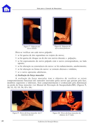 Guia para o Controle da Hanseníase




                         Figura 7 - Palpação do                     Figura 8 - Palpação do
                             nervo fibular                          nervo tibial posterior

             Deve-se verificar em cada nervo palpado:
             • se há queixa de dor espontânea no trajeto do nervo;
             • se há queixa de choque ou de dor nos nervos durante a palpação;
             • se há espessamento do nervo palpado com o nervo correspondente, no lado
               oposto;
             • se há alteração na consistência do nervo: se há endurecimento, amolecimento;
             • se há alteração na forma do nervo: se existem abcessos e nódulos;
             • se o nervo apresenta aderências.
             c) Avaliação da força muscular
              A avaliação da força muscular tem o objetivo de verificar se existe
     comprometimento funcional dos músculos inervados pelos nervos que passam pela face,
     membros superiores e inferiores. Este comprometimento é evidenciado pela diminuição
     ou perda da força muscular (ver Manual de Prevenção de Incapacidades/MS) (Figuras 9,
     10, 11, 12, 13, 14, 15 e 16).




          Figura 9 - Prova da força muscular do 1 o              Figura 10 - Prova da força muscular do
                      interósseo dorsal                                   abdutor do 5 o dedo



24                                           Cadernos da Atenção Básica
 