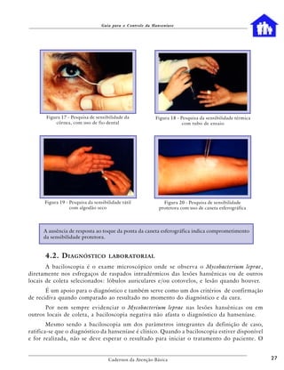 Guia para o Controle da Hanseníase




       Figura 17 - Pesquisa de sensibilidade da            Figura 18 - Pesquisa da sensibilidade térmica
           córnea, com uso de fio dental                                com tubo de ensaio




      Figura 19 - Pesquisa da sensibilidade tátil              Figura 20 - Pesquisa de sensibilidade
                  com algodão seco                           protetora com uso de caneta esferográfica




      A ausência de resposta ao toque da ponta da caneta esferográfica indica comprometimento
      da sensibilidade protetora.


      4.2. D IAGNÓSTICO              LABORATORIAL

       A baciloscopia é o exame microscópico onde se observa o Mycobacterium leprae,
diretamente nos esfregaços de raspados intradérmicos das lesões hansênicas ou de outros
locais de coleta selecionados: lóbulos auriculares e/ou cotovelos, e lesão quando houver.
       É um apoio para o diagnóstico e também serve como um dos critérios de confirmação
de recidiva quando comparado ao resultado no momento do diagnóstico e da cura.
      Por nem sempre evidenciar o Mycobacterium leprae nas lesões hansênicas ou em
outros locais de coleta, a baciloscopia negativa não afasta o diagnóstico da hanseníase.
        Mesmo sendo a baciloscopia um dos parâmetros integrantes da definição de caso,
ratifica-se que o diagnóstico da hanseníase é clínico. Quando a baciloscopia estiver disponível
e for realizada, não se deve esperar o resultado para iniciar o tratamento do paciente. O


                                     Cadernos da Atenção Básica                                            27
 