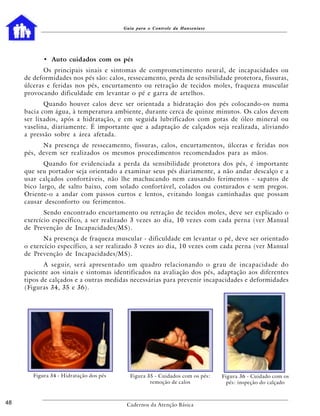 Guia para o Controle da Hanseníase




            • Auto cuidados com os pés
            Os principais sinais e sintomas de comprometimento neural, de incapacidades ou
     de deformidades nos pés são: calos, ressecamento, perda de sensibilidade protetora, fissuras,
     úlceras e feridas nos pés, encurtamento ou retração de tecidos moles, fraqueza muscular
     provocando dificuldade em levantar o pé e garra de artelhos.
            Quando houver calos deve ser orientada a hidratação dos pés colocando-os numa
     bacia com água, à temperatura ambiente, durante cerca de quinze minutos. Os calos devem
     ser lixados, após a hidratação, e em seguida lubrificados com gotas de óleo mineral ou
     vaselina, diariamente. É importante que a adaptação de calçados seja realizada, aliviando
     a pressão sobre a área afetada.
           Na presença de ressecamento, fissuras, calos, encurtamentos, úlceras e feridas nos
     pés, devem ser realizados os mesmos procedimentos recomendados para as mãos.
            Quando for evidenciada a perda da sensibilidade protetora dos pés, é importante
     que seu portador seja orientado a examinar seus pés diariamente, a não andar descalço e a
     usar calçados confortáveis, não lhe machucando nem causando ferimentos - sapatos de
     bico largo, de salto baixo, com solado confortável, colados ou costurados e sem pregos.
     Oriente-o a andar com passos curtos e lentos, evitando longas caminhadas que possam
     causar desconforto ou ferimentos.
            Sendo encontrado encurtamento ou retração de tecidos moles, deve ser explicado o
     exercício específico, a ser realizado 3 vezes ao dia, 10 vezes com cada perna (ver Manual
     de Prevenção de Incapacidades/MS).
            Na presença de fraqueza muscular - dificuldade em levantar o pé, deve ser orientado
     o exercício específico, a ser realizado 3 vezes ao dia, 10 vezes com cada perna (ver Manual
     de Prevenção de Incapacidades/MS).
            A seguir, será apresentado um quadro relacionando o grau de incapacidade do
     paciente aos sinais e sintomas identificados na avaliação dos pés, adaptação aos diferentes
     tipos de calçados e a outras medidas necessárias para prevenir incapacidades e deformidades
     (Figuras 34, 35 e 36).




        Figura 34 - Hidratação dos pés     Figura 35 - Cuidados com os pés:   Figura 36 - Cuidado com os
                                                   remoção de calos             pés: inspeção do calçado



48                                        Cadernos da Atenção Básica
 
