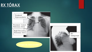 RX TÓRAX
Imagen de "árbol podado"
 