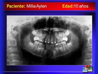 Paciente: MillaAylen Edad:10 años
 