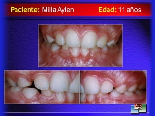 Paciente: MillaAylen Edad:11 años
 