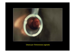 Úlcera por Trichomonas vaginalis

 