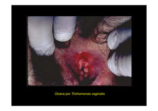 Úlcera por Trichomonas vaginalis

 