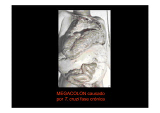 MEGACOLON causado
por T. cruzi fase crónica

 