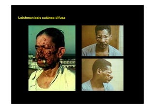 Leishmaniasis cutánea difusa

 