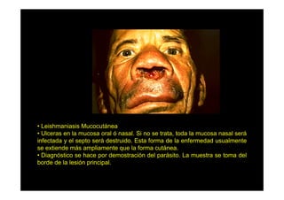• Leishmaniasis Mucocutánea
• Ulceras en la mucosa oral ó nasal. Si no se trata, toda la mucosa nasal será
infectada y el septo será destruido. Esta forma de la enfermedad usualmente
se extiende más ampliamente que la forma cutánea.
• Diagnóstico se hace por demostración del parásito. La muestra se toma del
borde de la lesión principal.

 