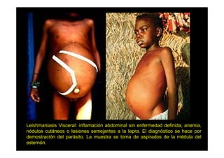 Leishmaniasis Visceral: inflamación abdominal sin enfermedad definida, anemia,
j
p
g
p
nódulos cutáneos o lesiones semejantes a la lepra. El diagnóstico se hace por
demostración del parásito. La muestra se toma de aspirados de la médula del
esternón.

 