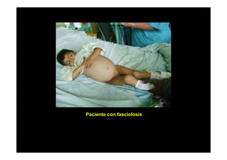 Paciente con fasciolosis

 