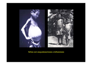 Niños con esquistosomosis o bilharziosis

 