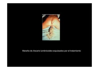 Maraña de Ascaris lumbricoides expulsados por el tratamiento

 