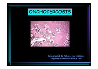 ONCHOCERCOSIS

Enfermedad de Robles, mal morado,
ceguera o fili i i de los ríos
filiariosis d l
í

 