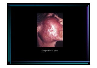 Erisipela de la costa

 