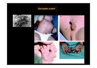 Sarcoptes scabei

 