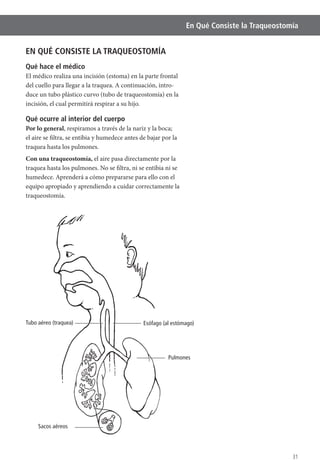 En Qué Consiste la Traqueostomía
31
Esófago (al estómago)Tubo aéreo (traquea)
Pulmones
Sacos aéreos
EN QUÉ CONSISTE LA TRAQUEOSTOMÍA
Qué hace el médico
del cuello para llegar a la traquea. A continuación, intro-
duce un tubo plástico curvo (tubo de traqueostomía) en la
incisión, el cual permitirá respirar a su hijo.
Qué ocurre al interior del cuerpo
Por lo general, respiramos a través de la nariz y la boca;
el aire se filtra, se entibia y humedece antes de bajar por la
traquea hasta los pulmones.
Con una traqueostomía, el aire pasa directamente por la
traquea hasta los pulmones. No se filtra, ni se entibia ni se
humedece. Aprenderá a cómo prepararse para ello con el
equipo apropiado y aprendiendo a cuidar correctamente la
traqueostomía.
 