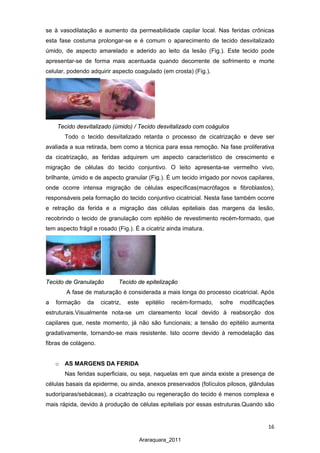 16
Araraquara_2011
se à vasodilatação e aumento da permeabilidade capilar local. Nas feridas crônicas
esta fase costuma prolongar-se e é comum o aparecimento de tecido desvitalizado
úmido, de aspecto amarelado e aderido ao leito da lesão (Fig.). Este tecido pode
apresentar-se de forma mais acentuada quando decorrente de sofrimento e morte
celular, podendo adquirir aspecto coagulado (em crosta) (Fig.).
Tecido desvitalizado (úmido) / Tecido desvitalizado com coágulos
Todo o tecido desvitalizado retarda o processo de cicatrização e deve ser
avaliada a sua retirada, bem como a técnica para essa remoção. Na fase proliferativa
da cicatrização, as feridas adquirem um aspecto característico de crescimento e
migração de células do tecido conjuntivo. O leito apresenta-se vermelho vivo,
brilhante, úmido e de aspecto granular (Fig.). É um tecido irrigado por novos capilares,
onde ocorre intensa migração de células específicas(macrófagos e fibroblastos),
responsáveis pela formação do tecido conjuntivo cicatricial. Nesta fase também ocorre
e retração da ferida e a migração das células epiteliais das margens da lesão,
recobrindo o tecido de granulação com epitélio de revestimento recém-formado, que
tem aspecto frágil e rosado (Fig.). É a cicatriz ainda imatura.
Tecido de Granulação Tecido de epitelização
A fase de maturação é considerada a mais longa do processo cicatricial. Após
a formação da cicatriz, este epitélio recém-formado, sofre modificações
estruturais.Visualmente nota-se um clareamento local devido à reabsorção dos
capilares que, neste momento, já não são funcionais; a tensão do epitélio aumenta
gradativamente, tornando-se mais resistente. Isto ocorre devido à remodelação das
fibras de colágeno.
o AS MARGENS DA FERIDA
Nas feridas superficiais, ou seja, naquelas em que ainda existe a presença de
células basais da epiderme, ou ainda, anexos preservados (folículos pilosos, glândulas
sudoríparas/sebáceas), a cicatrização ou regeneração do tecido é menos complexa e
mais rápida, devido à produção de células epiteliais por essas estruturas.Quando são
 
