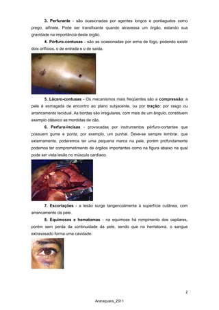 2
Araraquara_2011
3. Perfurante - são ocasionadas por agentes longos e pontiagudos como
prego, alfinete. Pode ser transfixante quando atravessa um órgão, estando sua
gravidade na importância deste órgão.
4. Pérfuro-contusas - são as ocasionadas por arma de fogo, podendo existir
dois orifícios, o de entrada e o de saída.
5. Lácero-contusas - Os mecanismos mais freqüentes são a compressão: a
pele é esmagada de encontro ao plano subjacente, ou por tração: por rasgo ou
arrancamento tecidual. As bordas são irregulares, com mais de um ângulo; constituem
exemplo clássico as mordidas de cão.
6. Perfuro-incisas - provocadas por instrumentos pérfuro-cortantes que
possuem gume e ponta, por exemplo, um punhal. Deve-se sempre lembrar, que
externamente, poderemos ter uma pequena marca na pele, porém profundamente
podemos ter comprometimento de órgãos importantes como na figura abaixo na qual
pode ser vista lesão no músculo cardíaco.
7. Escoriações - a lesão surge tangencialmente à superfície cutânea, com
arrancamento da pele.
8. Equimoses e hematomas - na equimose há rompimento dos capilares,
porém sem perda da continuidade da pele, sendo que no hematoma, o sangue
extravasado forma uma cavidade.
 