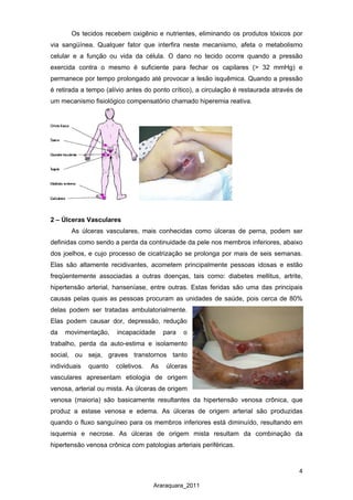 4
Araraquara_2011
Os tecidos recebem oxigênio e nutrientes, eliminando os produtos tóxicos por
via sangüínea. Qualquer fator que interfira neste mecanismo, afeta o metabolismo
celular e a função ou vida da célula. O dano no tecido ocorre quando a pressão
exercida contra o mesmo é suficiente para fechar os capilares (> 32 mmHg) e
permanece por tempo prolongado até provocar a lesão isquêmica. Quando a pressão
é retirada a tempo (alívio antes do ponto crítico), a circulação é restaurada através de
um mecanismo fisiológico compensatório chamado hiperemia reativa.
2 – Úlceras Vasculares
As úlceras vasculares, mais conhecidas como úlceras de perna, podem ser
definidas como sendo a perda da continuidade da pele nos membros inferiores, abaixo
dos joelhos, e cujo processo de cicatrização se prolonga por mais de seis semanas.
Elas são altamente recidivantes, acometem principalmente pessoas idosas e estão
freqüentemente associadas a outras doenças, tais como: diabetes mellitus, artrite,
hipertensão arterial, hanseníase, entre outras. Estas feridas são uma das principais
causas pelas quais as pessoas procuram as unidades de saúde, pois cerca de 80%
delas podem ser tratadas ambulatorialmente.
Elas podem causar dor, depressão, redução
da movimentação, incapacidade para o
trabalho, perda da auto-estima e isolamento
social, ou seja, graves transtornos tanto
individuais quanto coletivos. As úlceras
vasculares apresentam etiologia de origem
venosa, arterial ou mista. As úlceras de origem
venosa (maioria) são basicamente resultantes da hipertensão venosa crônica, que
produz a estase venosa e edema. As úlceras de origem arterial são produzidas
quando o fluxo sanguíneo para os membros inferiores está diminuído, resultando em
isquemia e necrose. As úlceras de origem mista resultam da combinação da
hipertensão venosa crônica com patologias arteriais periféricas.
 