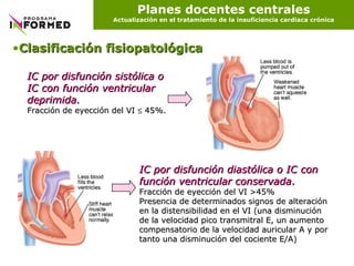Planes docentes centrales Actualización en el tratamiento de la insuficiencia cardiaca crónica Clasificación fisiopatológica             IC por disfunción sistólica o IC con función ventricular deprimida.   Fracción de eyección del VI    45%. IC por disfunción diastólica o IC con función ventricular conservada . Fracción de eyección del VI >45%  Presencia de determinados signos de alteración en la distensibilidad en el VI (una disminución de la velocidad pico transmitral E, un aumento compensatorio de la velocidad auricular A y por tanto una disminución del cociente E/A) 