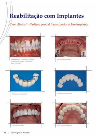 Guia orientacao implantes