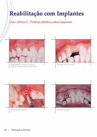 Guia orientacao implantes