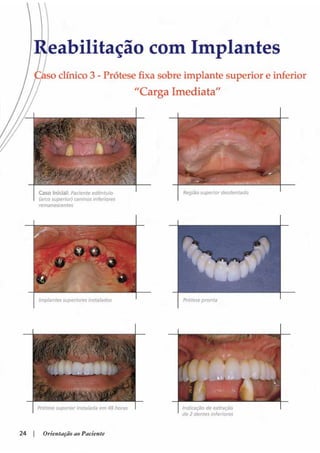 Guia orientacao implantes