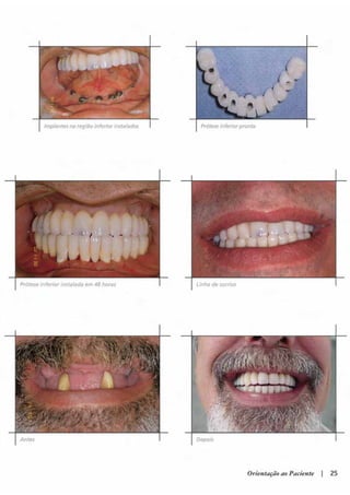 Guia orientacao implantes